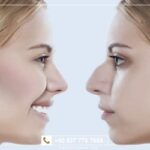 تكلفة تجميل الأنف في تركيا مع شركة البرنس .