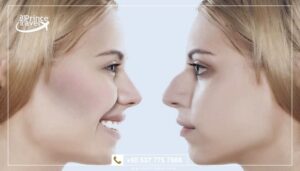 تكلفة تجميل الأنف في تركيا مع شركة البرنس .