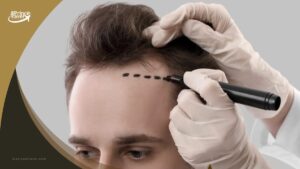 افضل مراكز زراعة الشعر في تركيا