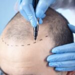 أفضل مكان لزراعة الشعر في العالم