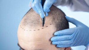 أفضل مكان لزراعة الشعر في العالم